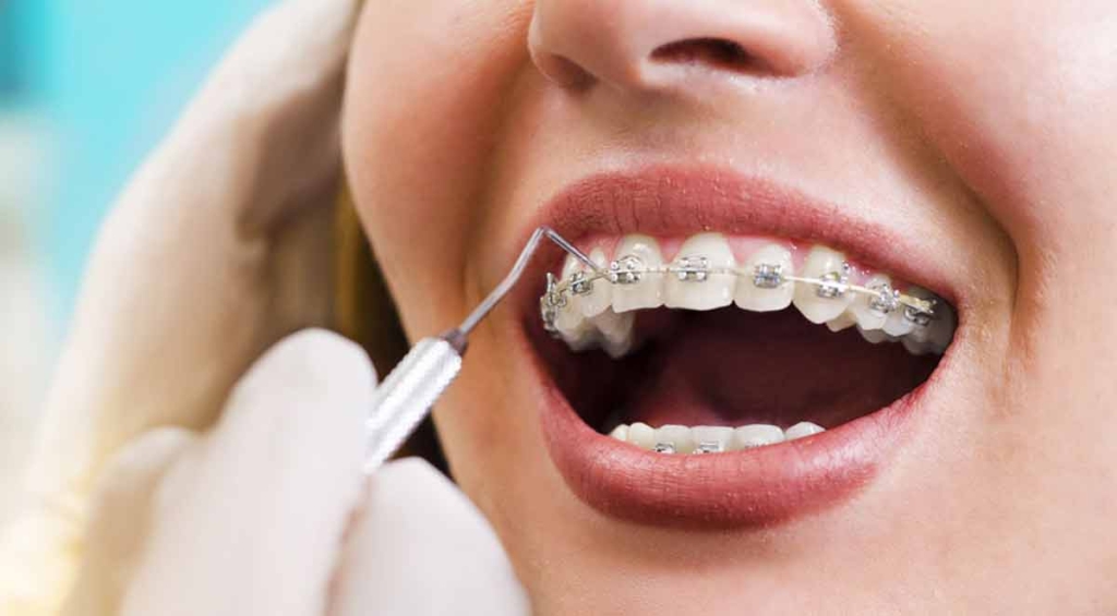 Ortodonti Diş Teli