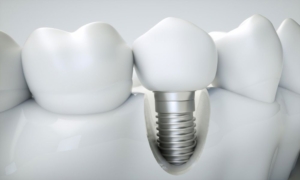 İmplant Tedavisi Nedir?
