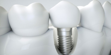 İmplant Tedavisi Nedir?